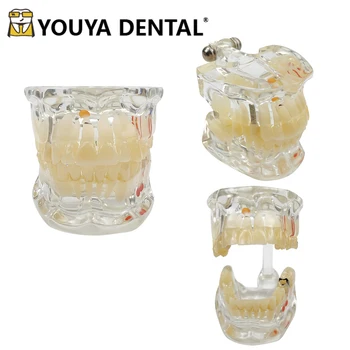 Doença Dentária Dentes Modelo De Implante De Dentes Modelo De Prática De Ensino De Formação De Estudar Oral De Medicina Odontologia Ferramentas